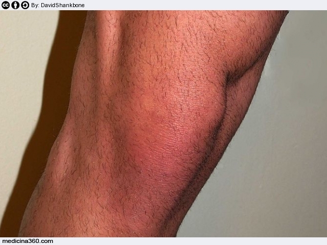 Artrosi al ginocchio: sintomi, cause e terapia della gonartrosi