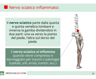 Pomata antinfiammatoria per nervo sciatico