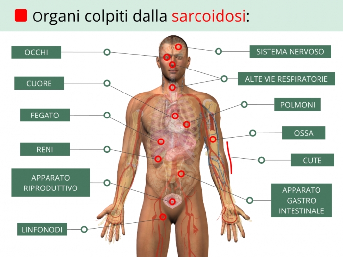 organi-sarcoidosi_700x525