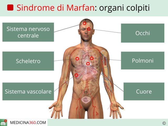sindrome-di-marfan_640x480