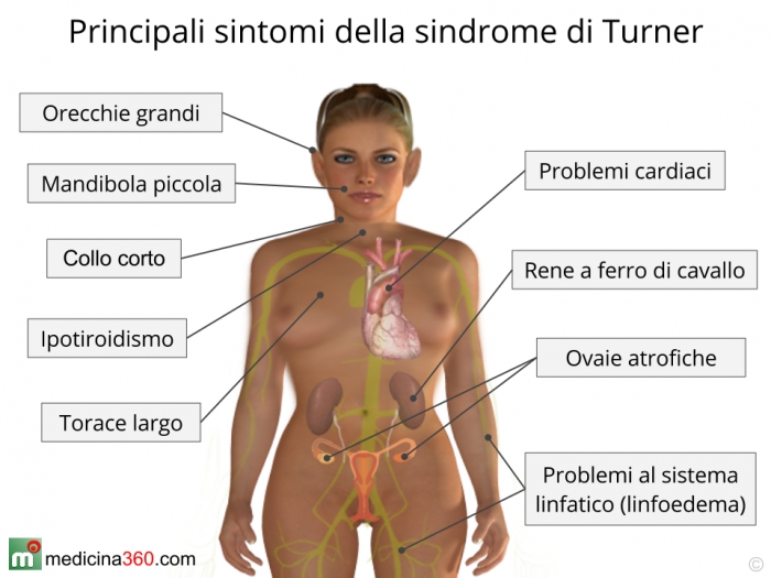 sintomi-sindrome-turner_700x525