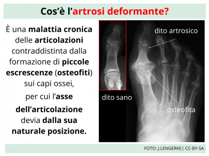 Artrosi Cervicale: Cura Definitiva Per Artrosi Cervicale