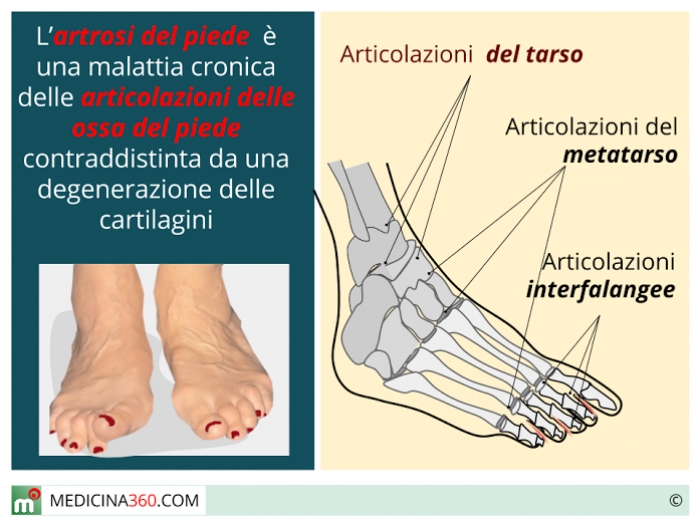 Scarpe per artrosi ai piedi