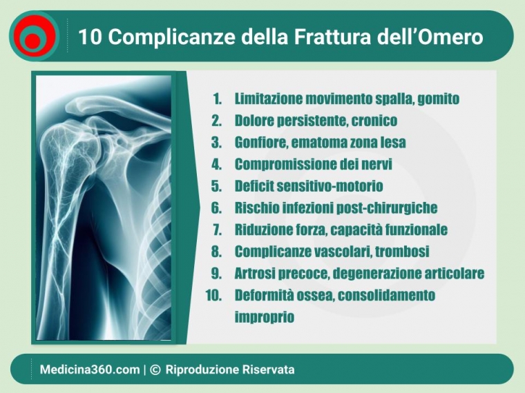 Complicanze della Frattura dell'Omero: Guida Completa e Consigli Pratici