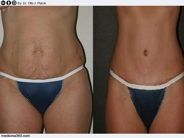 Costi dell'addominoplastica