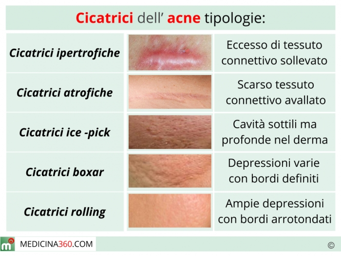 rimedi per le cicatrici da acne