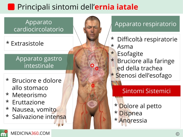 Ernia Iatale: Sintomi, Cause, Rimedi, Diagnosi, Cure