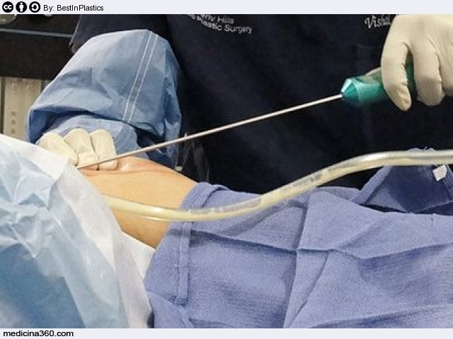 Liposcultura: cos’è? Quando farla? Tipi risultati e rischi