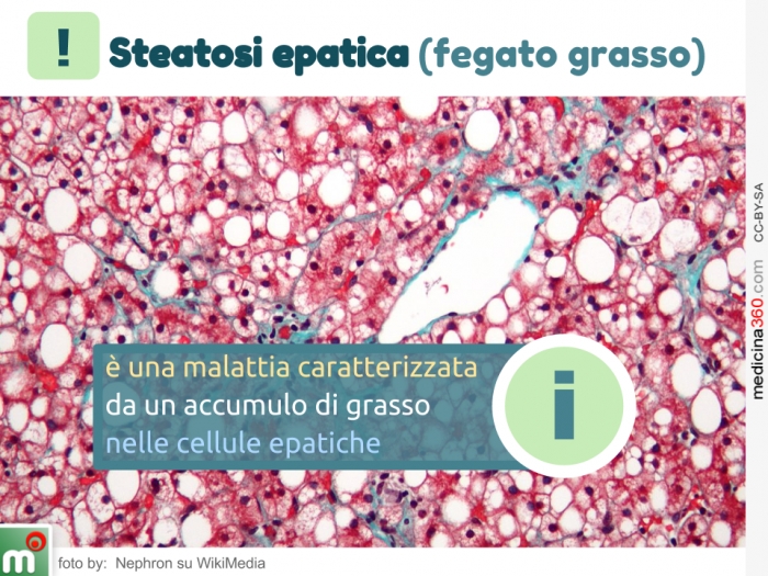 Стеатоз печени что это простыми словами. Стеатоз печени микропрепарат.