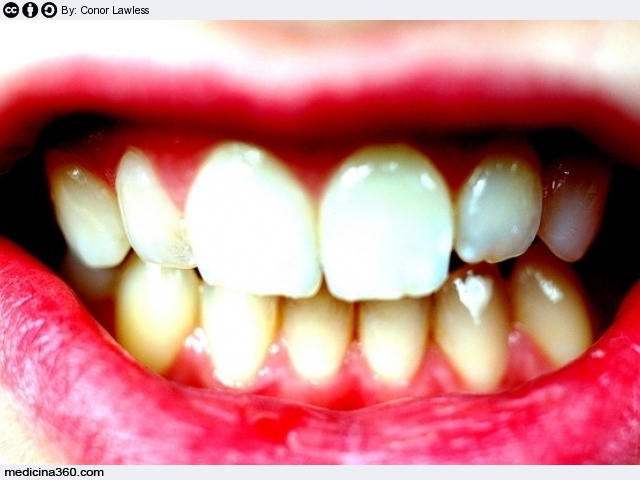 Tartaro: cause, prevenzione, rischi ed ablazione dei denti per eliminare il problema