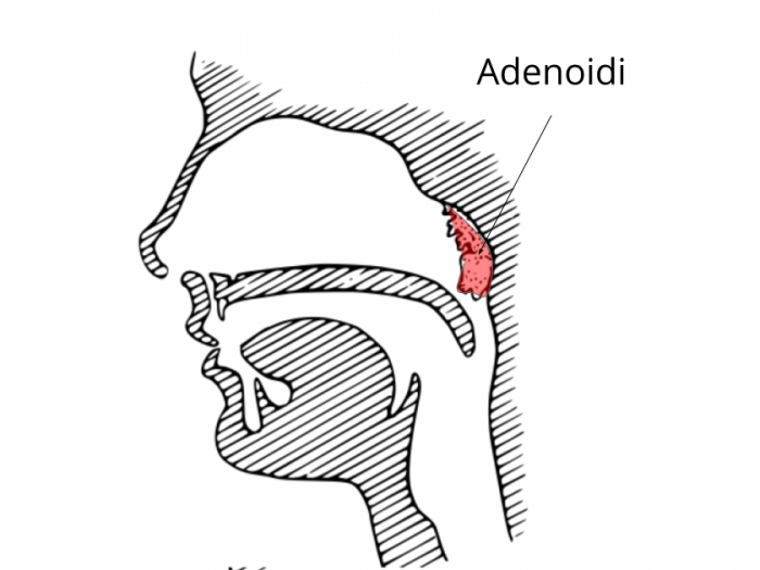 Где аденоиды у ребенка. Носоглотка аденоиды 3 степени. Анатомия ЛОР органов аденоиды. Гипертрофия носоглоточной миндалины 2 ст. Анатомия носоглотки аденоиды.