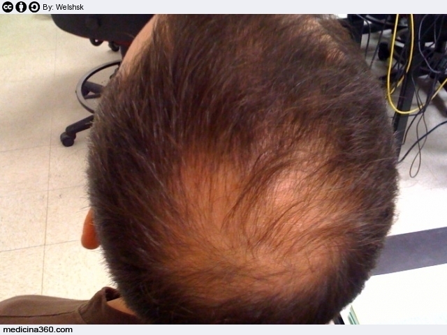 alopecia androgenetica cura naturale
