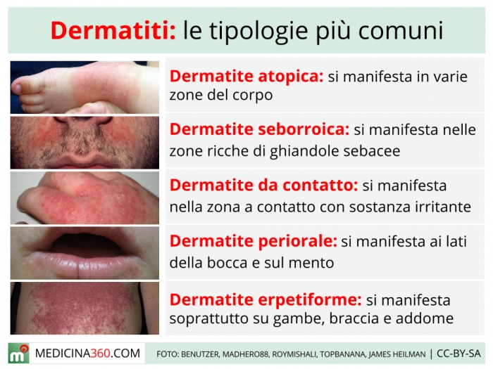 dermatite cause