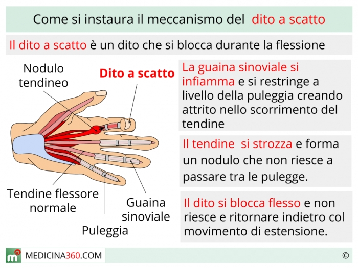 Dita delle mani a martello: cause, sintomi, pericoli e rimedi