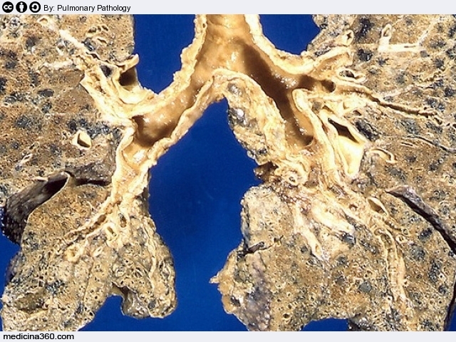 Enfisema polmonare