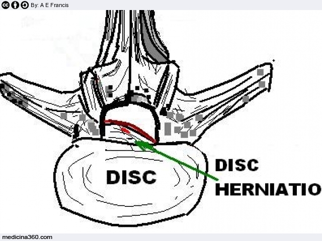 Ernia del disco: sintomi, cause, cure, intervento e conseguenze
