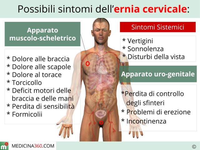 Mal di schiena cervicale o cervicalgia - Cos'è - Sintomi - Cause