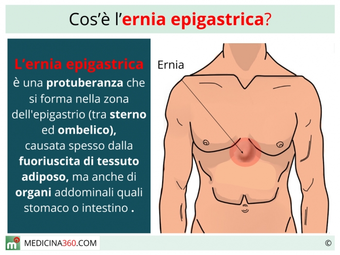 Ernia Epigastrica Sintomi Cause Diagnosi Ed Intervento