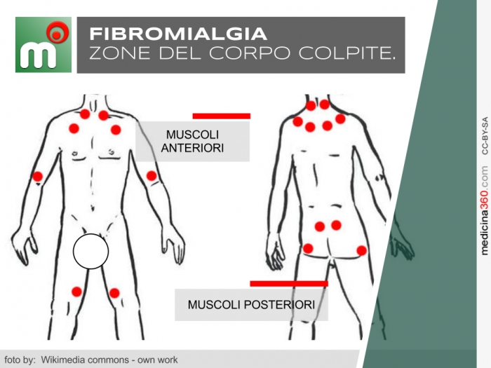 Fibromialgia Muscolare Sintomi Terapia Cure Cause E Diagnosi
