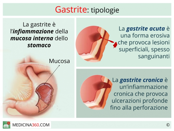 Gastrite Acuta E Cronica Sintomi Cause Rimedi E Rischi