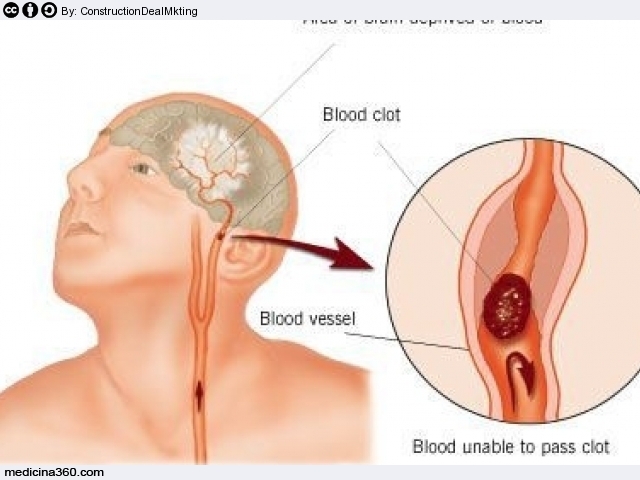 Ictus cerebrale