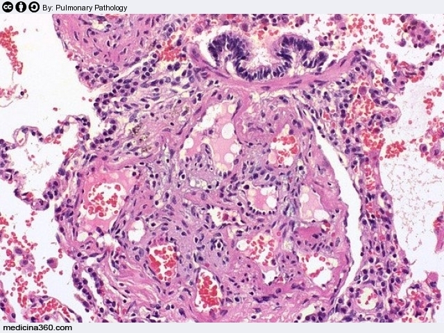 Ipertensione polmonare: sintomi cause terapia e linee guida