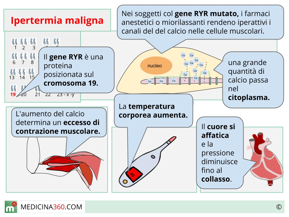 Ipertermia maligna: cause, sintomi e terapia 