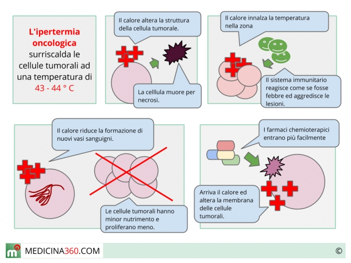 Ipertermia Oncologica Efficacia Ed Effetti Collaterali