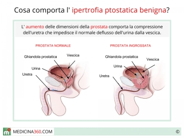 prostata ingrossata e tumore Egyszerűen prostatitis megkülönböztetése