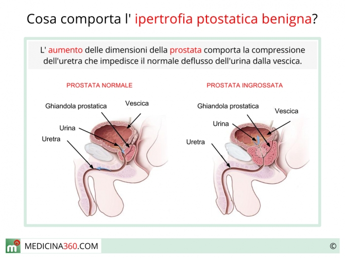 ingrossamento prostata e disfunzione erettile