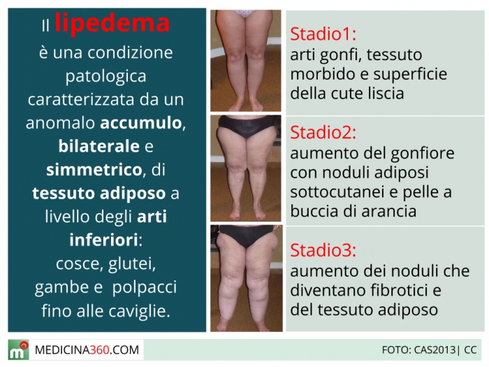 Lipedema: cos'è? Sintomi, cause, cura e dieta