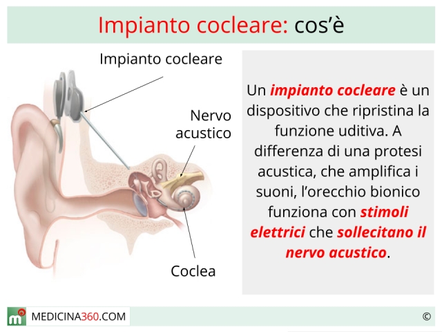 Impianto Cocleare: Quando Serve e Com'è Fatto