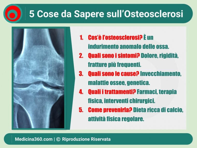 Osteosclerosi: Guida Completa sui Sintomi, Diagnosi e Trattamenti