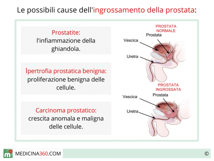 prostata ingrossata cause)