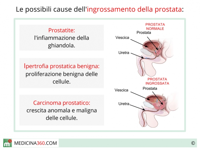 sintomi prostata ingrossata