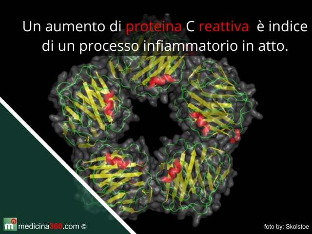  Proteina C reattiva alta