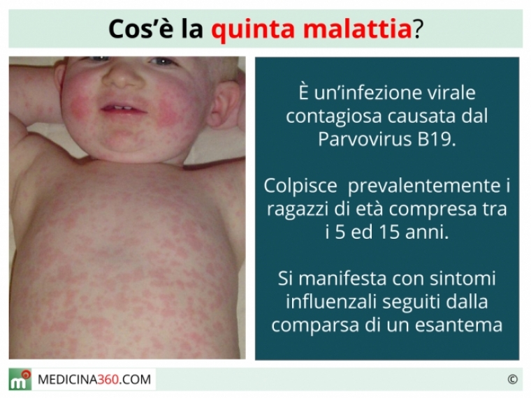 Quinta Malattia: Guida Completa sui Sintomi, Diagnosi, Trattamento e Prevenzione