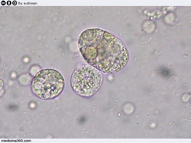 Sangue nelle urine