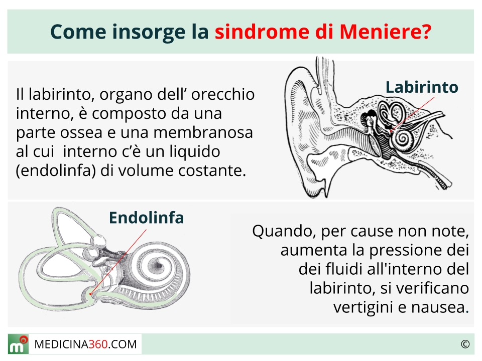 Sindrome di Meniere: sintomi, diagnosi e cura del morbo 