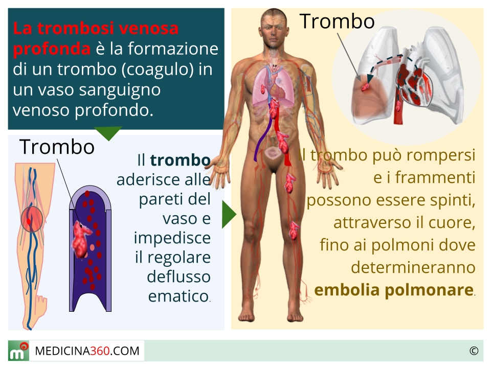  Trombosi venosa profonda o superficiale: sintomi, terapia, rischi e cause