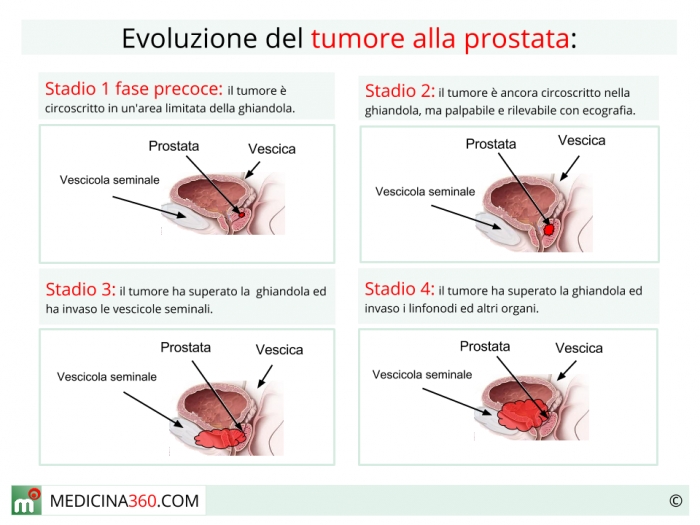 tumore prostata sintomi metastasi