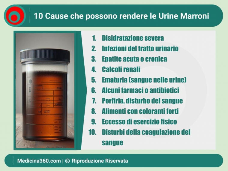Urine Marroni: Cause, Diagnosi e Trattamenti - Guida Completa