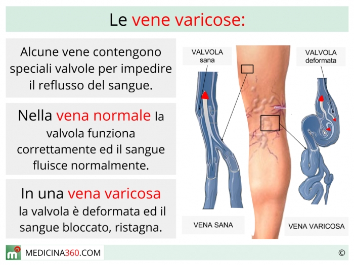 Vene varicoase ale bolii CVD